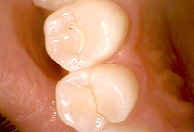 Close up of molars